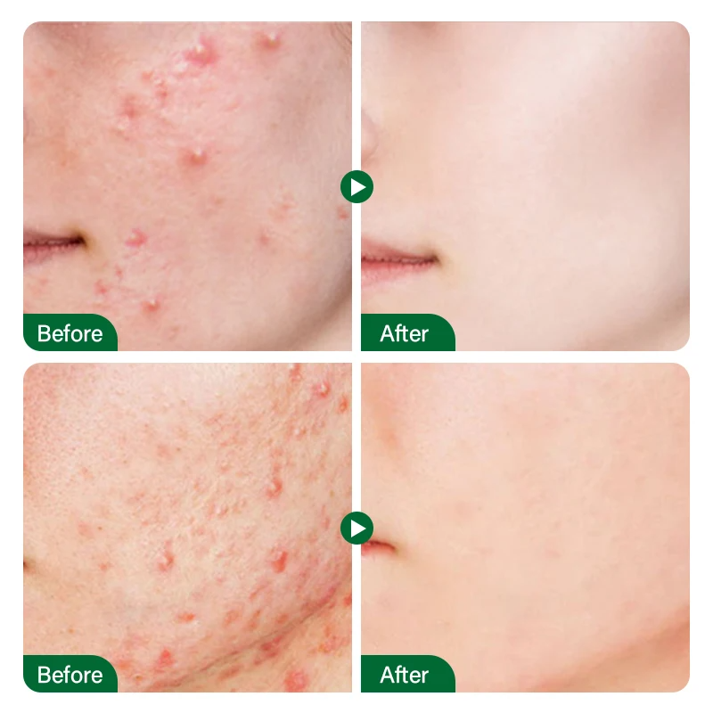 Face Serum & Dark Spot Correcting Serum for Glowing Skin | Acne Skin Care Products 30ml