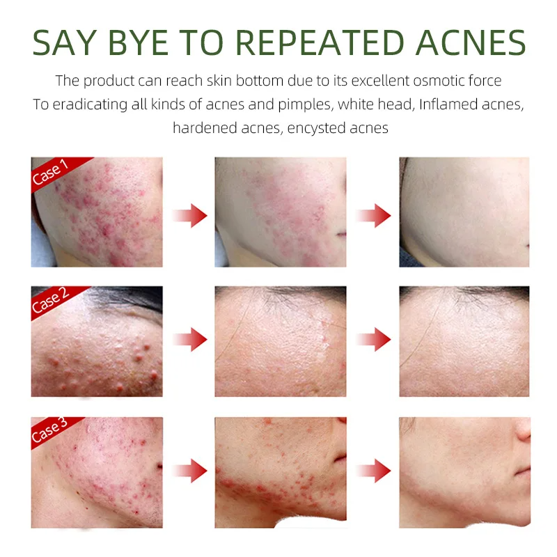 Face Serum & Dark Spot Correcting Serum for Glowing Skin | Acne Skin Care Products 30ml