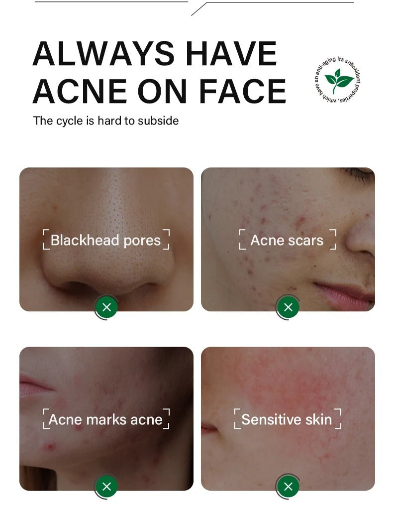 Face Serum & Dark Spot Correcting Serum for Glowing Skin | Acne Skin Care Products 30ml