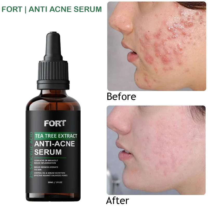 Face Serum & Dark Spot Correcting Serum for Glowing Skin | Acne Skin Care Products 30ml